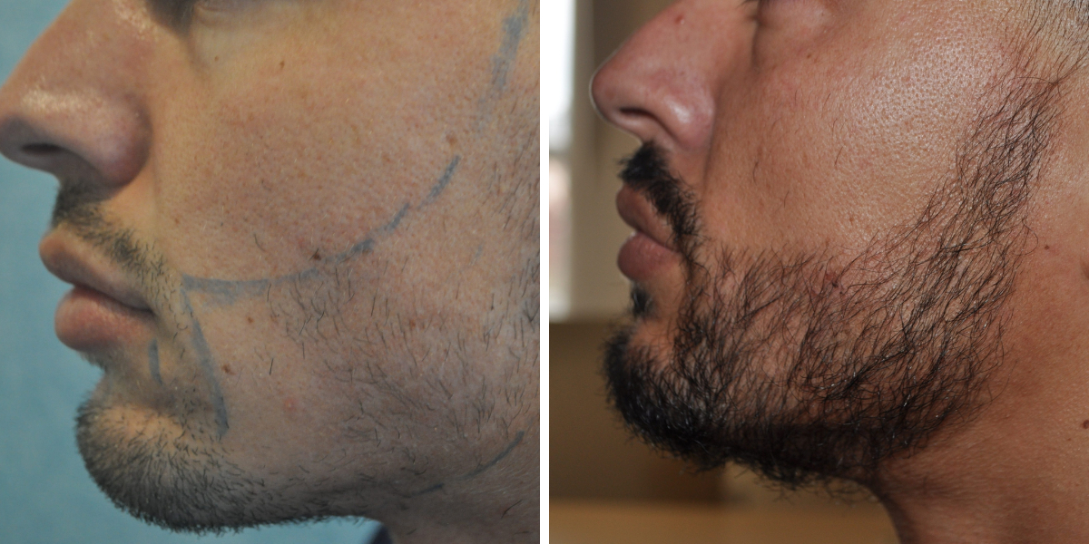 Conor Benn’s Beard Transplant: Results & Reaction, Wimpole Clinic