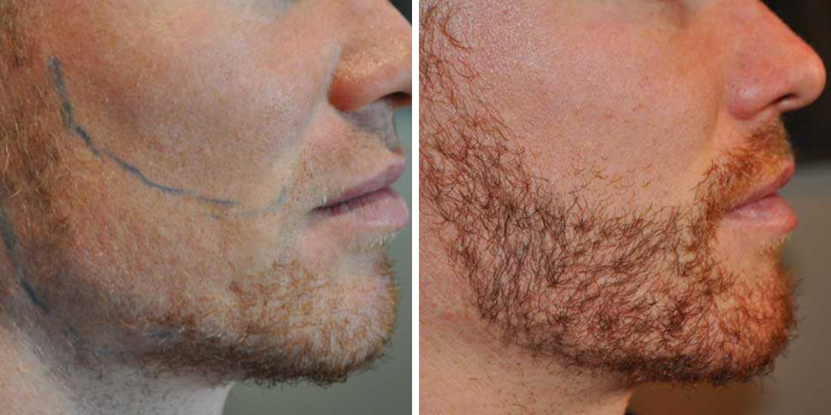 Beard Transplant Turkey: How To Choose A Clinic in 2026, Wimpole Clinic