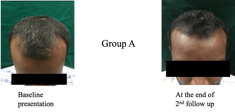 Procapil: Does It Really Stop Hair Loss?, Wimpole Clinic