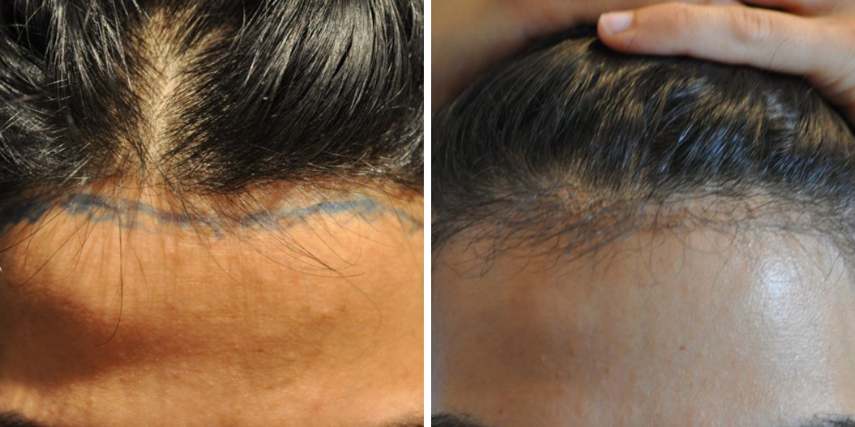baby hair growth before and after hair transplant