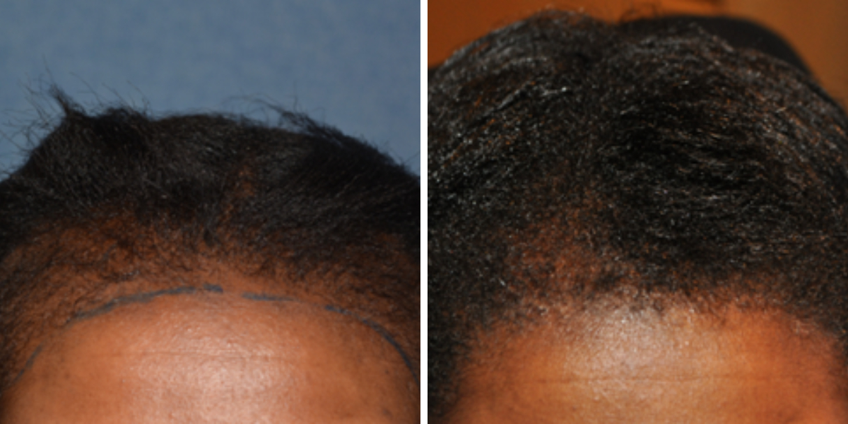 before and after traction alopecia hair transplant 2