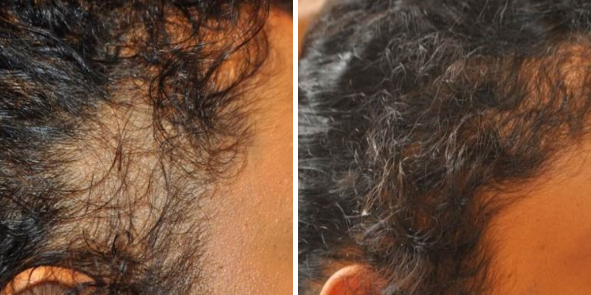 before and after traction alopecia hair transplant