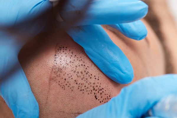 Hairline Tattoo Featured Image