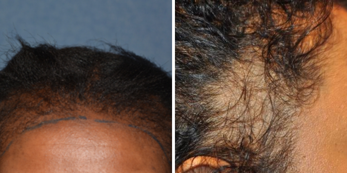 traction alopecia examples