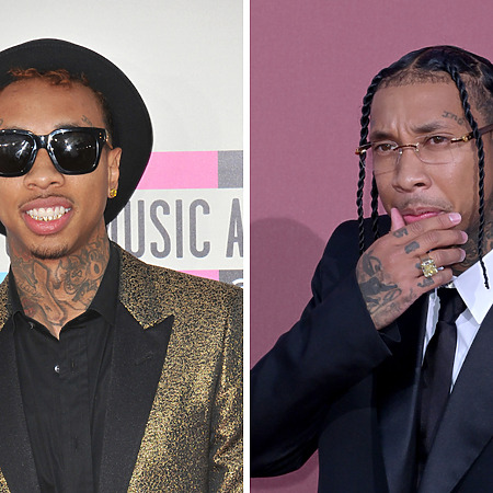tyga hair transplant featured image