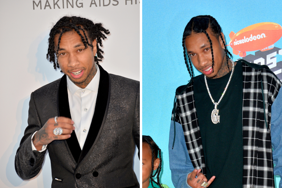 Tyga’s Hair Transplant: Results, Costs & Photo Analysis, Wimpole Clinic