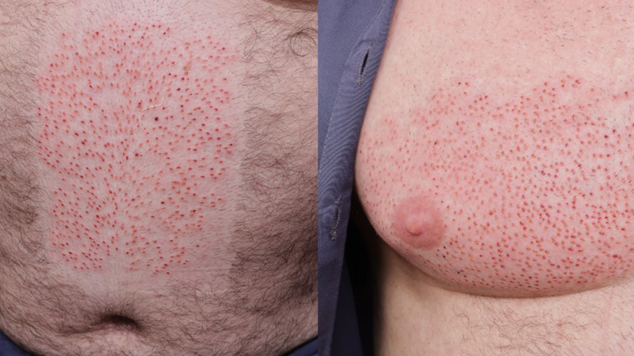 How Do Body Hair Transplants Work?