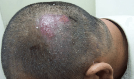Folliculitis After Hair Transplant
