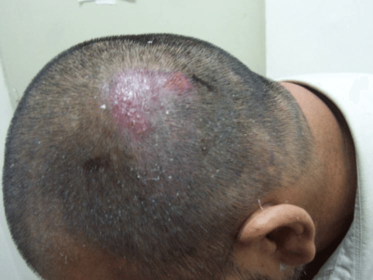 Folliculitis After Hair Transplant