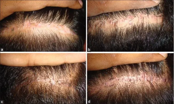 healed FUT scars