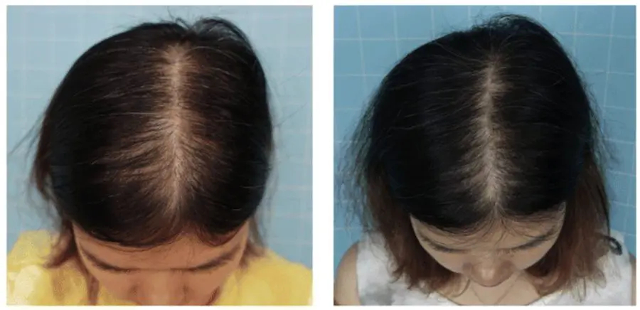 Woman before and after 6 months of Minoxidil
