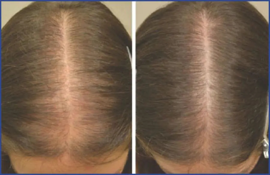 Does topical Minoxidil work for women? Before and after results in female pattern hair loss patient