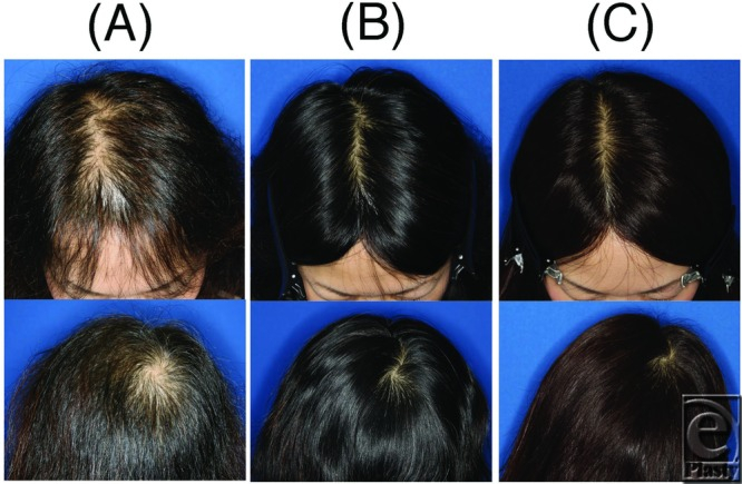 Results of stem cell treatment on a female hair transplant