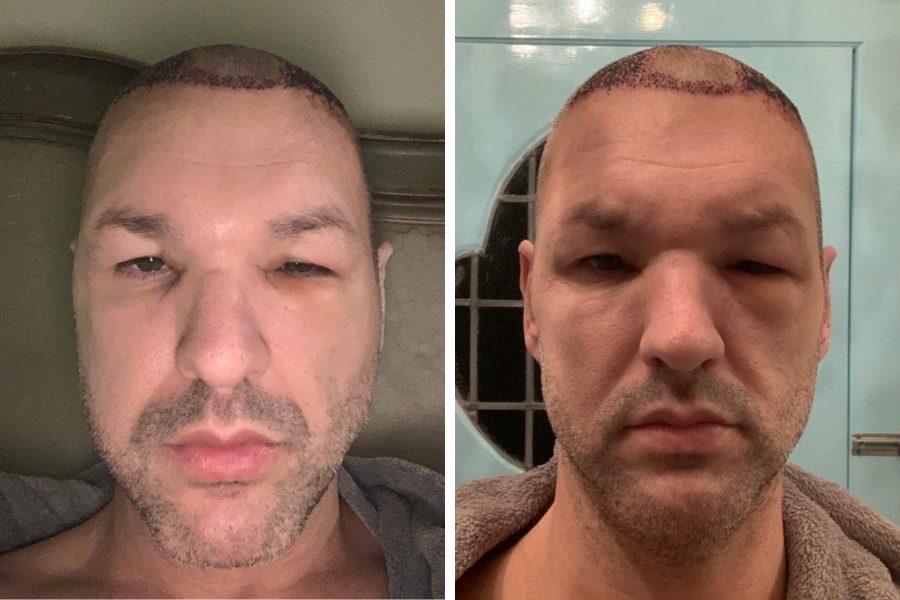 How To Prevent And Reduce Hair Transplant Swelling