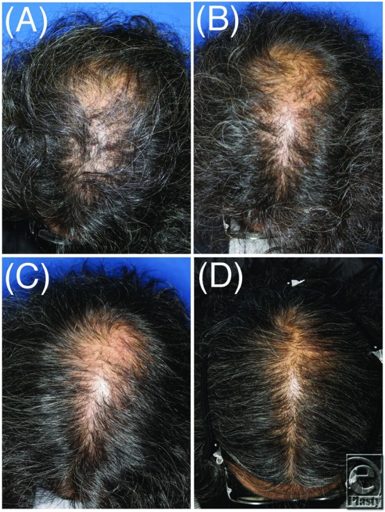 before and after stem cell hair transplant