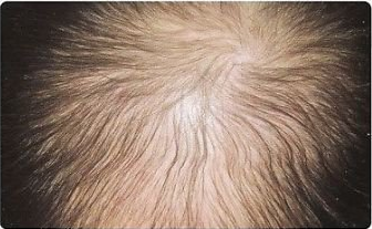 Woman with medication-induced hair loss