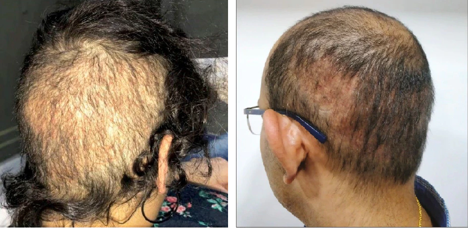 hair transplant overharvesting examples