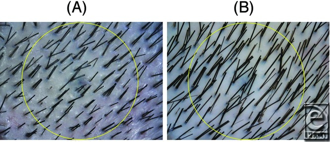 hair density before and after 7 months of stem cell treatment