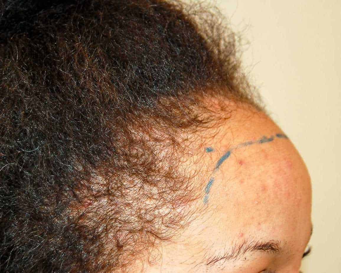 Afro Hair Transplant, Wimpole Clinic