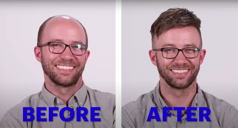 Results of using a mens hair system