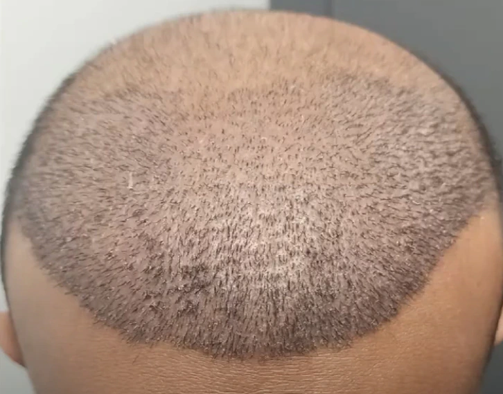 Hair Transplant After 10 Days: Photos, Results & Aftercare