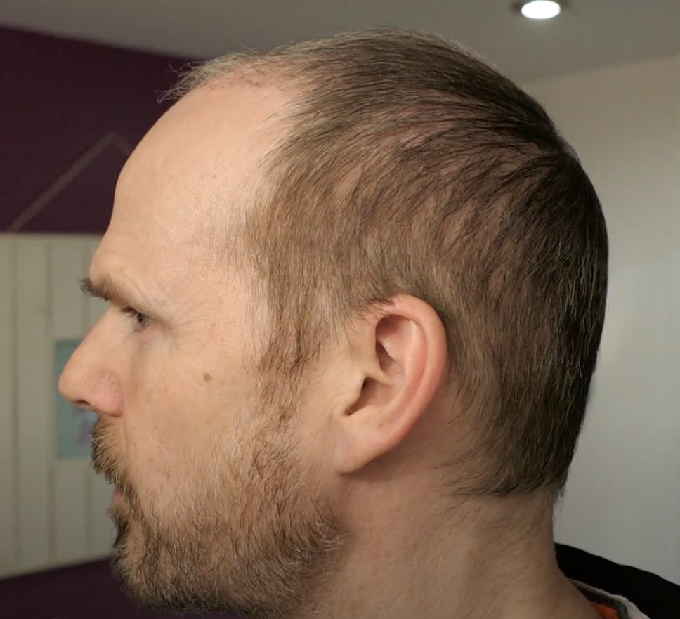 Donor area 2 months post hair transplant surgery