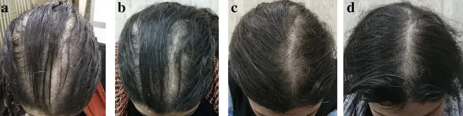 Results in female pattern hair loss patient over 6 months of using topical Minoxidil solution